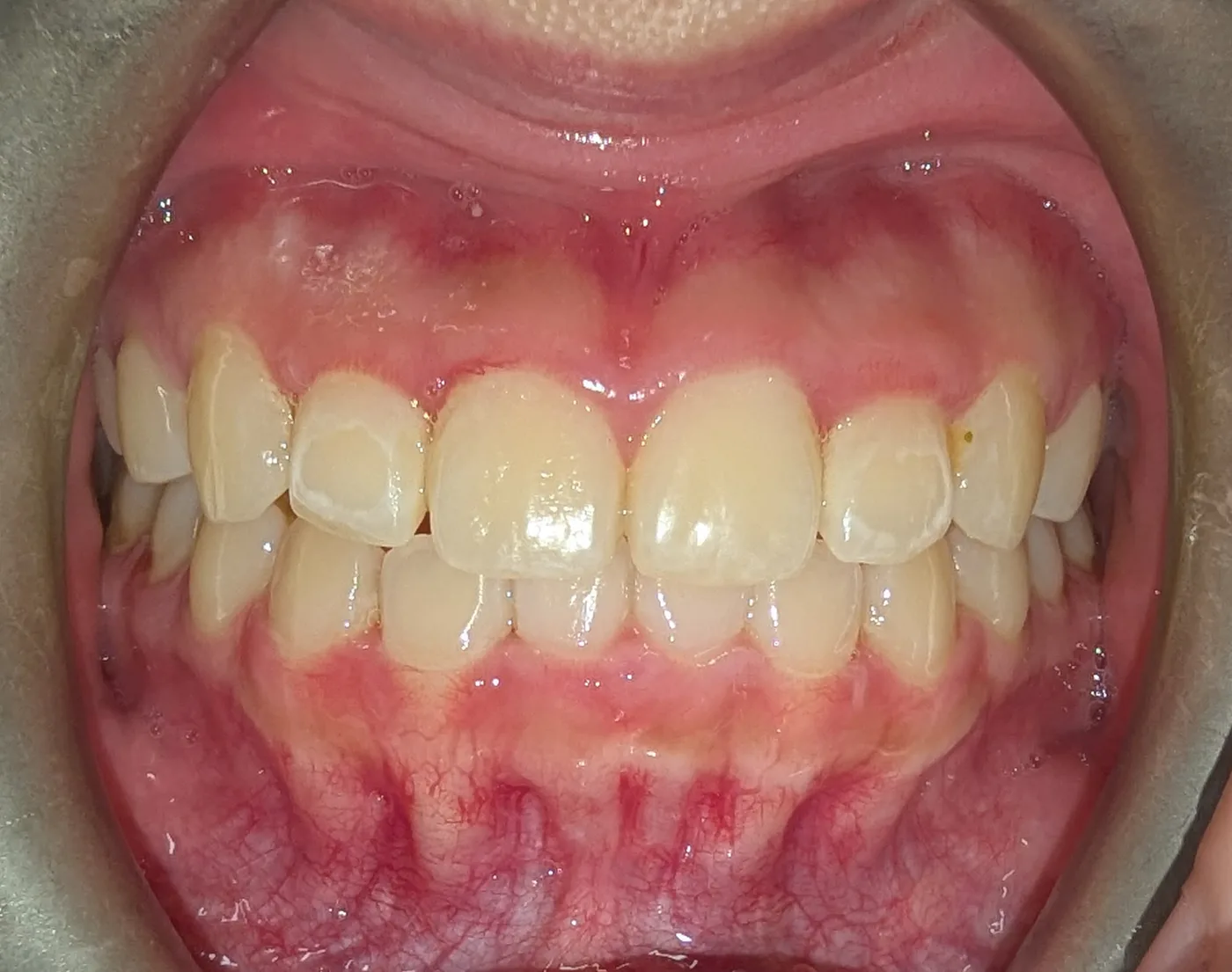 After — Crowding corrected · 12 months