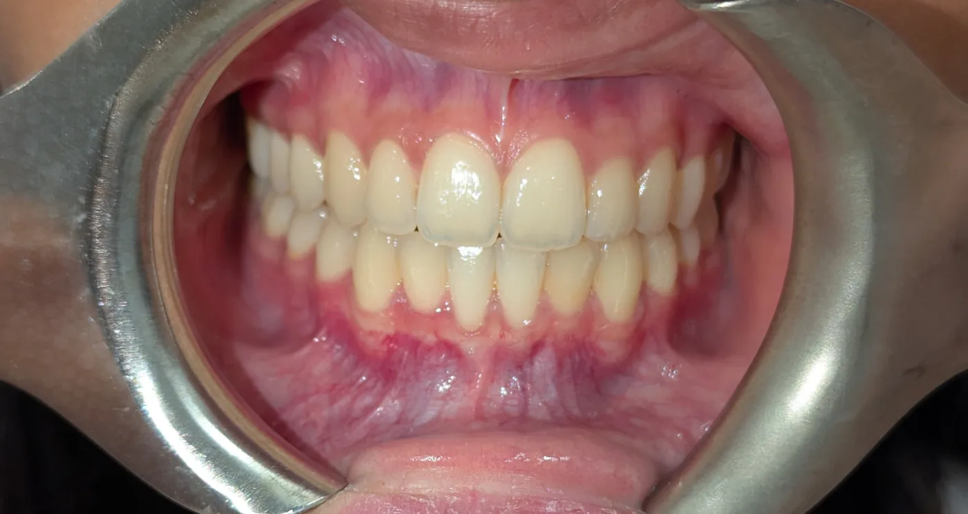 After — Spacing closed · 10 months