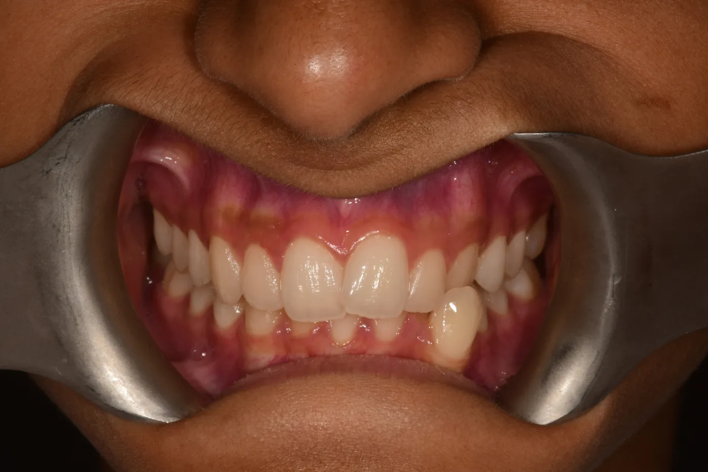 Before — Spacing closed · 10 months
